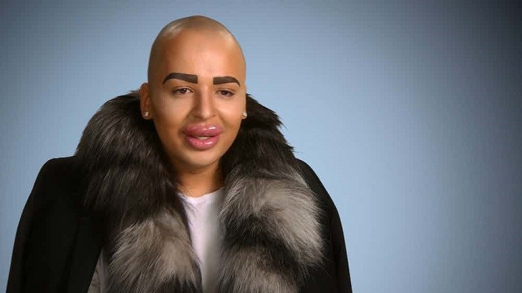 lip implants lip implants